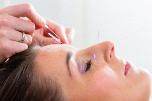 Acupuncture-single-treatment_109082959